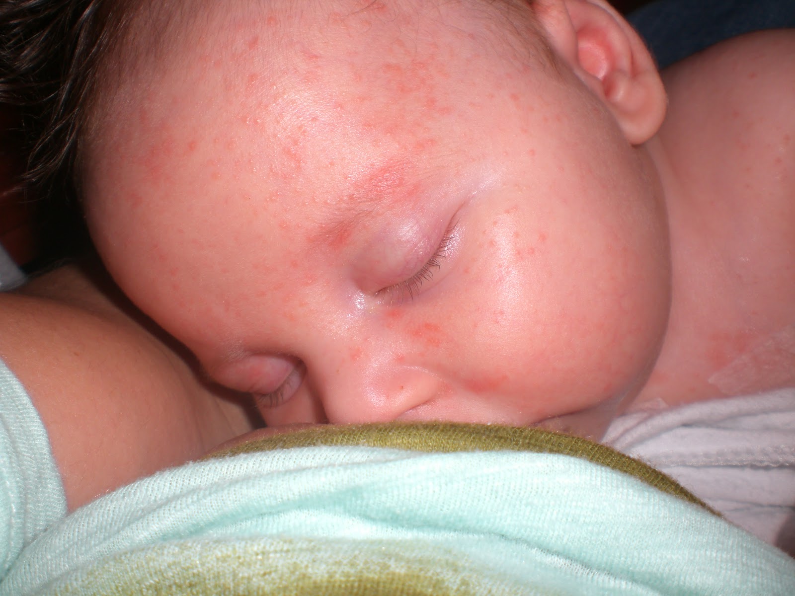 Meningitis Rash Baby Pictures