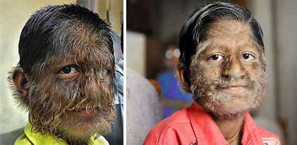 Werewolf Syndrome Facts