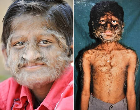 Werewolf Syndrome Pictures