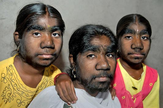 Werewolf Syndrome Sisters